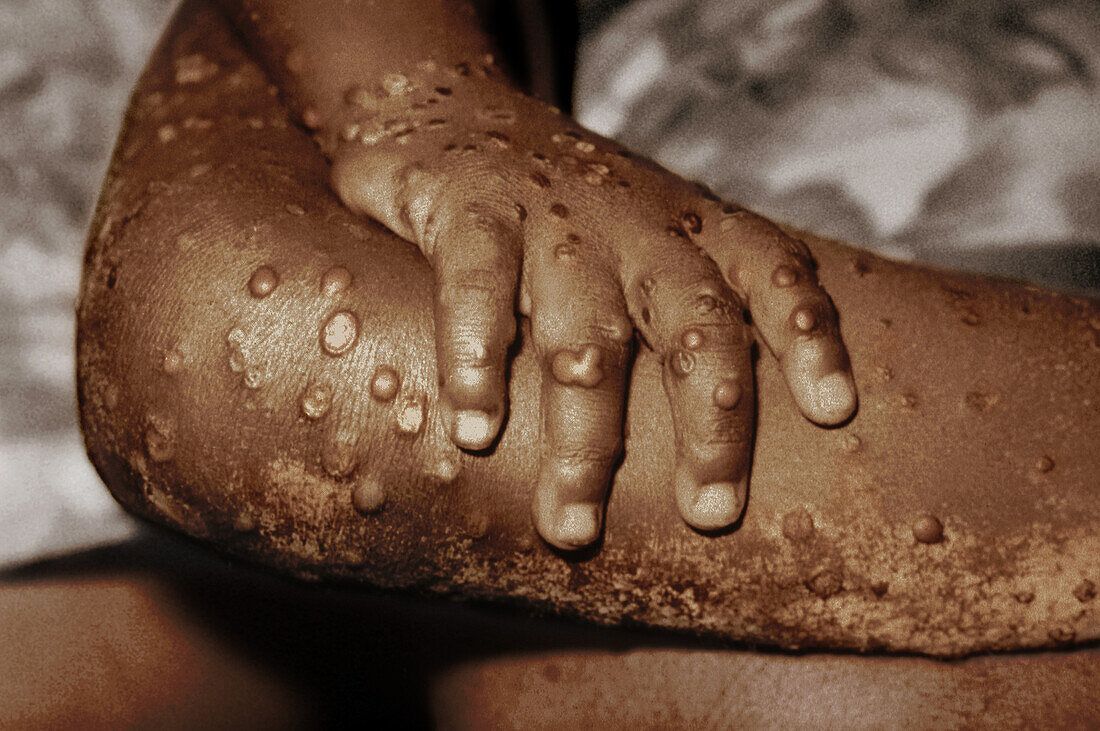Ghana’s Mpox cases soar to 302 as GHS confirms 20 new infections